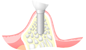インプラント